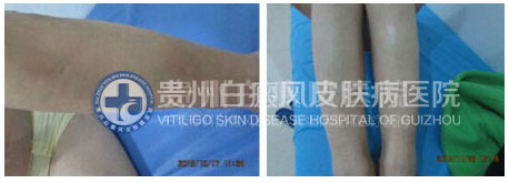 白斑比山重 治愈展笑颜