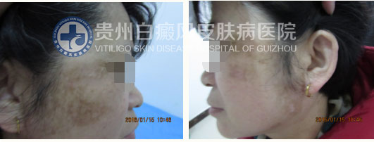 不明白斑让我遭到嫌弃,贵州白癜风皮肤病医院让我看到了希望