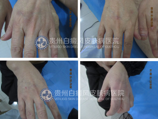 年近花甲白斑突袭,今朝康复送锦旗致谢