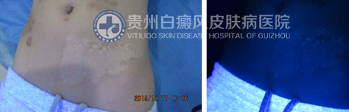 腹部白斑四年在我院三个月治愈