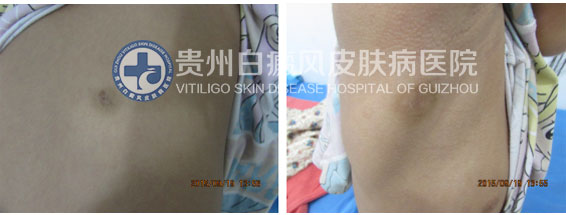 9岁女孩背部、腋下白斑在我院治愈