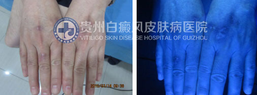 年近花甲白斑突袭,今朝康复送锦旗致谢