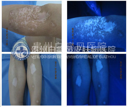 白斑比山重 治愈展笑颜