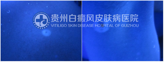 9岁女孩背部、腋下白斑在我院治愈