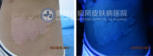 腹部白斑四年在我院三个月治愈