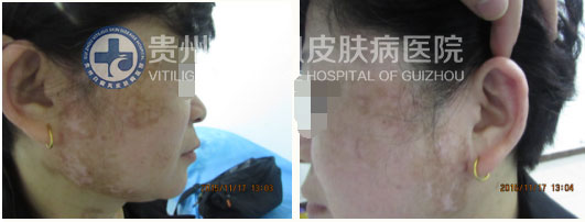 不明白斑让我遭到嫌弃,贵州白癜风皮肤病医院让我看到了希望