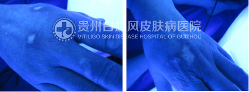 年近花甲白斑突袭,今朝康复送锦旗致谢