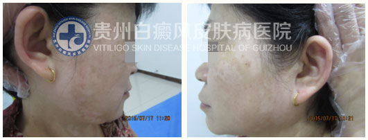 不明白斑让我遭到嫌弃,贵州白癜风皮肤病医院让我看到了希望