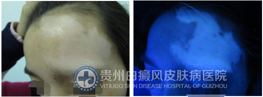 拯救“白眉女孩”行动,让青春不留遗憾