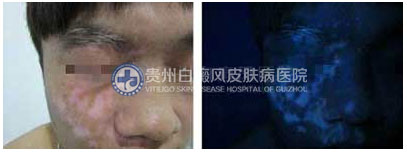 治愈白斑 重树自信闯天下