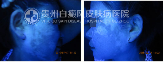 不明白斑让我遭到嫌弃,贵州白癜风皮肤病医院让我看到了希望