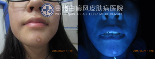 “痤疮”引发白斑告急,贵州白癜风医院助其恢复美丽容颜