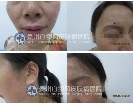 面部多处白斑终治愈,患者感恩送锦旗