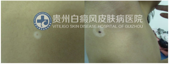 9岁女孩背部、腋下白斑在我院治愈