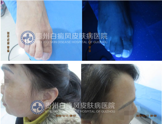 选择贵州白癜风皮肤病医院,和“白斑”说拜拜