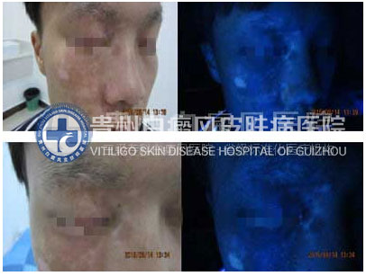 治愈白斑 重树自信闯天下