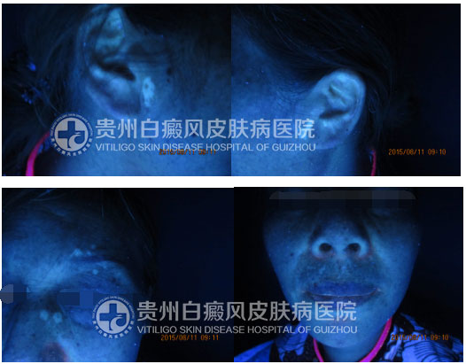 面部多处白斑终治愈,患者感恩送锦旗