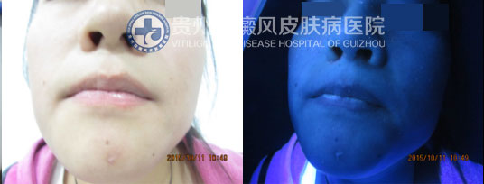 “痤疮”引发白斑告急,贵州白癜风医院助其恢复美丽容颜
