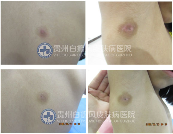 9岁女孩背部、腋下白斑在我院治愈