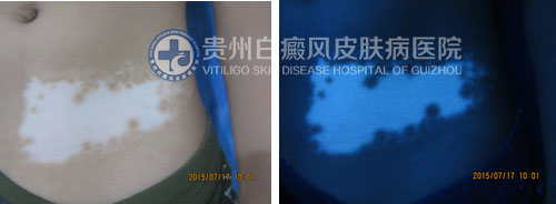 腹部白斑四年在我院三个月治愈