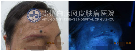 面部多处白斑终治愈,患者感恩送锦旗