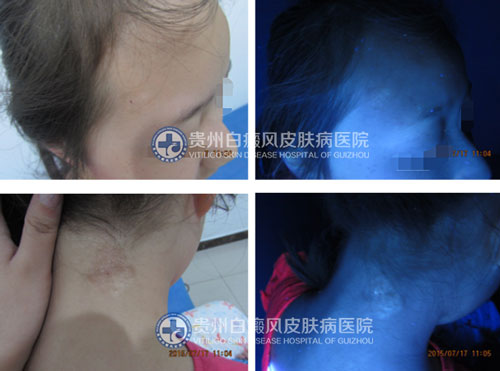 李女士 面部、颈部白斑三年