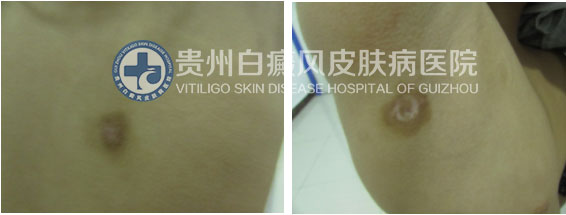 9岁女孩背部、腋下白斑在我院治愈