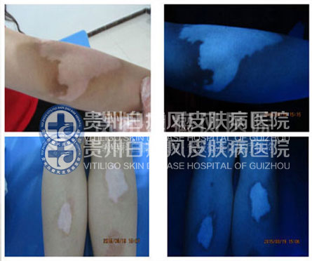 白斑比山重 治愈展笑颜