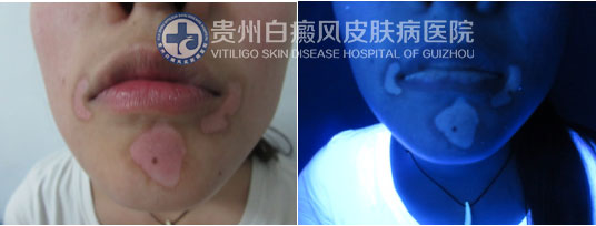 “痤疮”引发白斑告急,贵州白癜风医院助其恢复美丽容颜