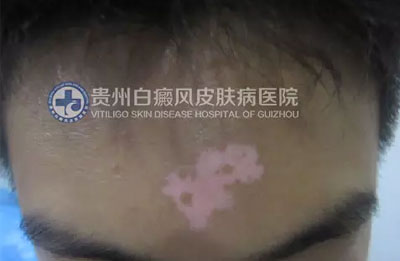 邹某 16岁 局限型-进展期白癜风 1年余
