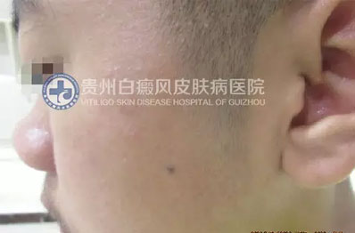 邹某 16岁 局限型-进展期白癜风 1年余