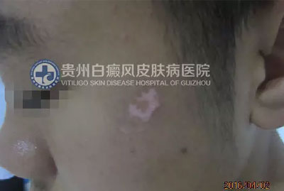 邹某 16岁 局限型-进展期白癜风 1年余