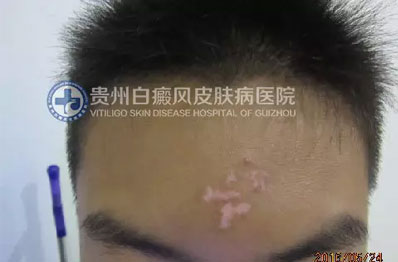 邹某 16岁 局限型-进展期白癜风 1年余