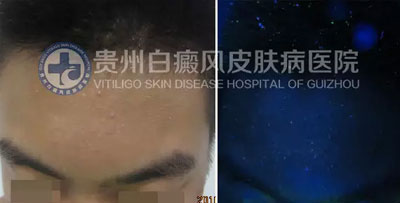 邹某 16岁 局限型-进展期白癜风 1年余