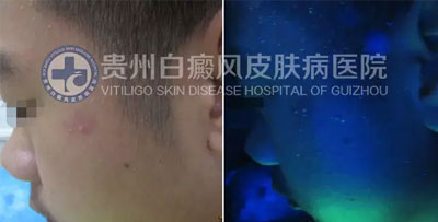 邹某 16岁 局限型-进展期白癜风 1年余