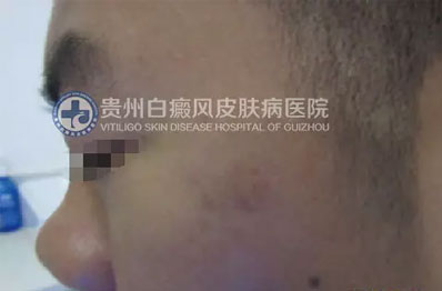 邹某 16岁 局限型-进展期白癜风 1年余