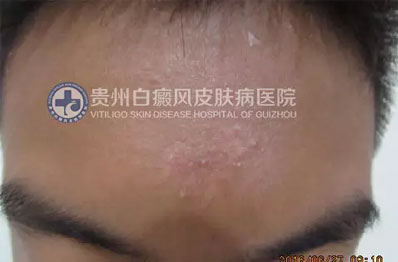 邹某 16岁 局限型-进展期白癜风 1年余