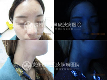 身上多处白斑终治愈,患者锦旗相送表谢意
