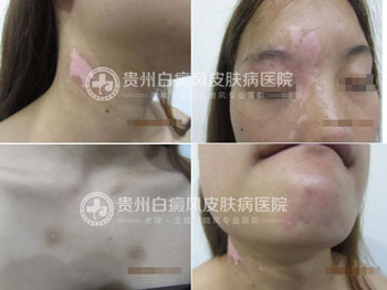 身上多处白斑终治愈,患者锦旗相送表谢意