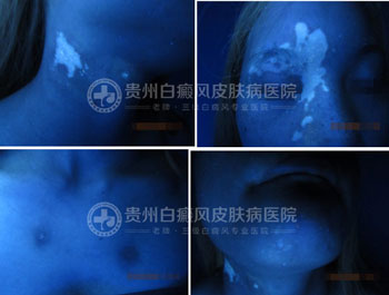 身上多处白斑终治愈,患者锦旗相送表谢意